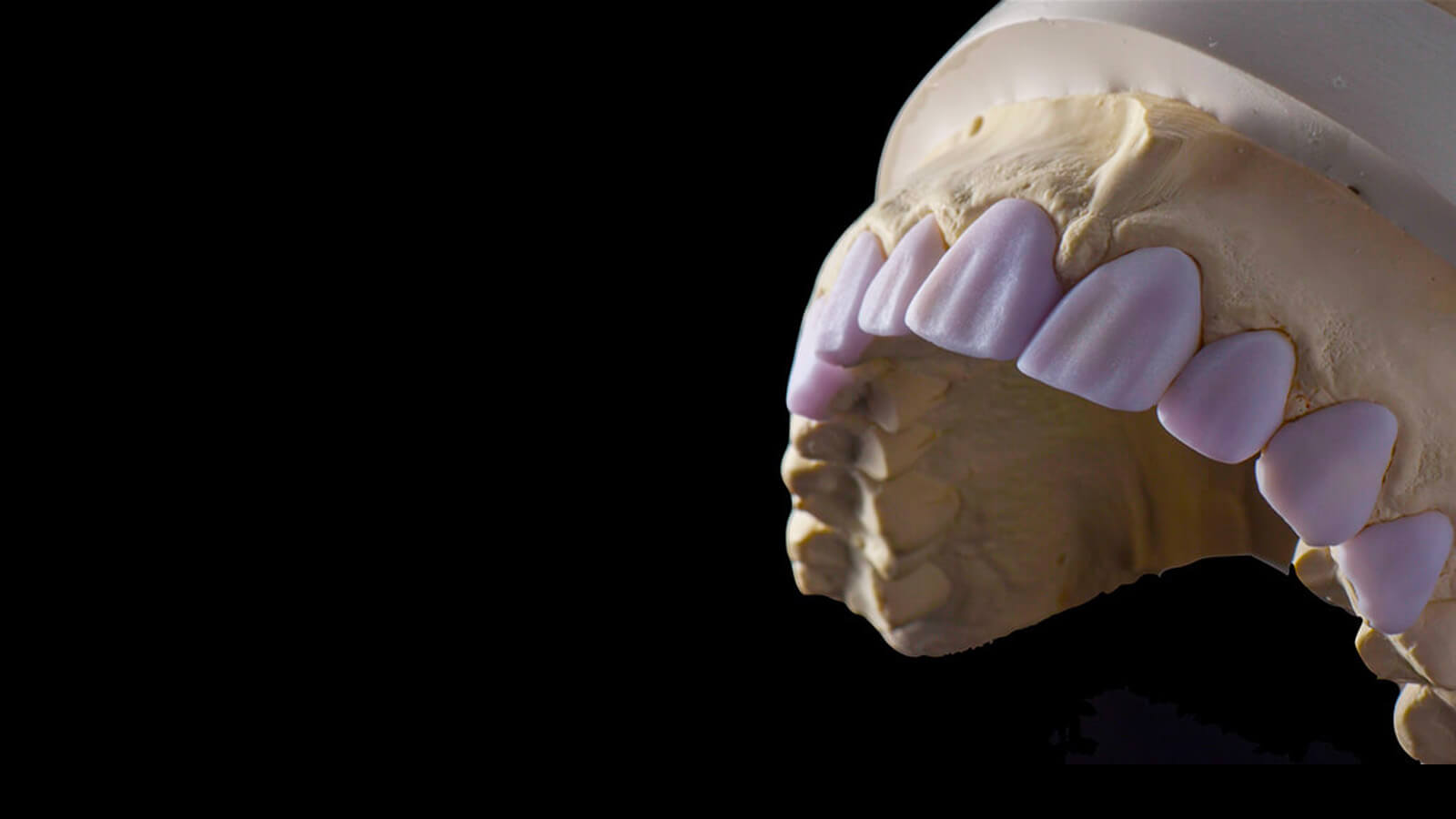 Zirconia Anteriors CE