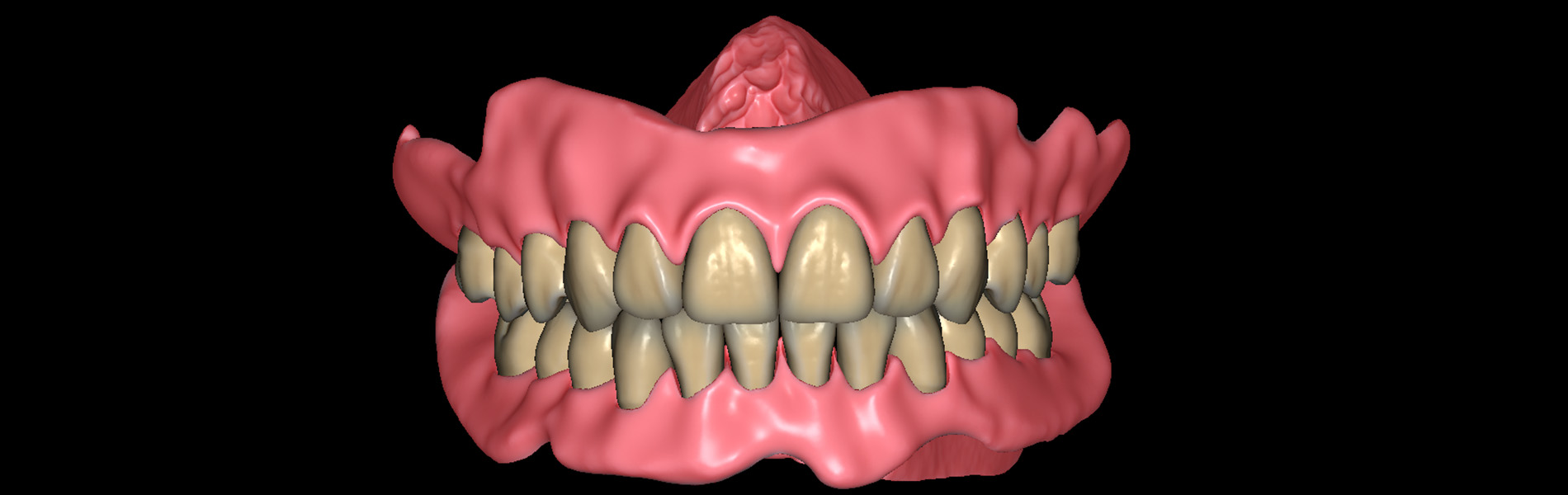Denture Color