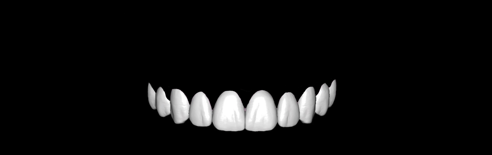 Veneers MOD Design Services